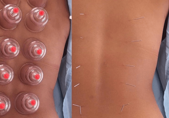 Introductory Workshop: Gua Sha, Cupping & Acupuncture
